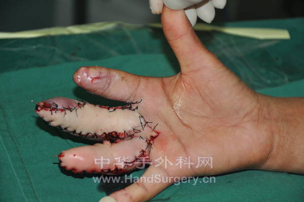游离足底内+游离拇趾腓侧