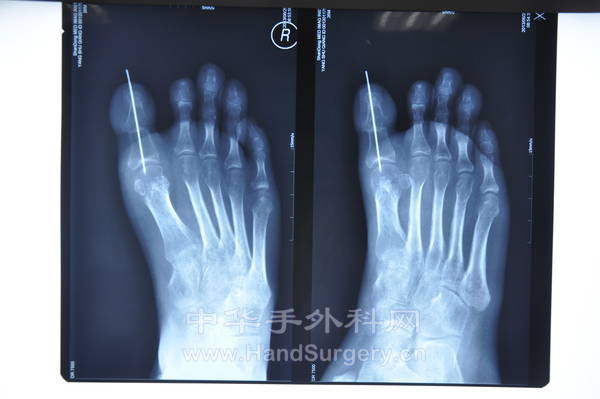 足趾再植