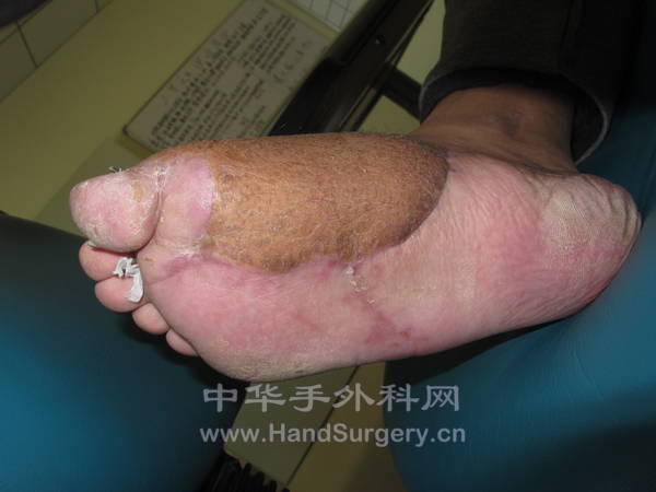 腓骨皮瓣