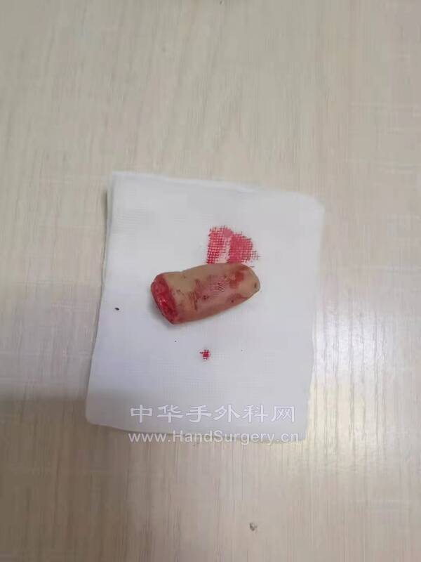 离断18小时指体