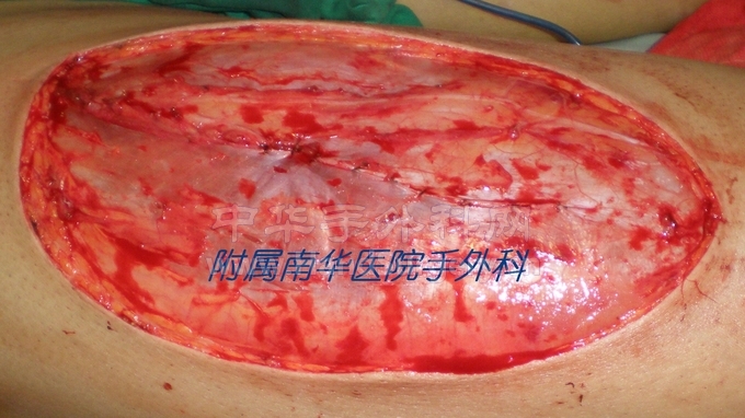 保留并缝合阔筋膜 减少并发症