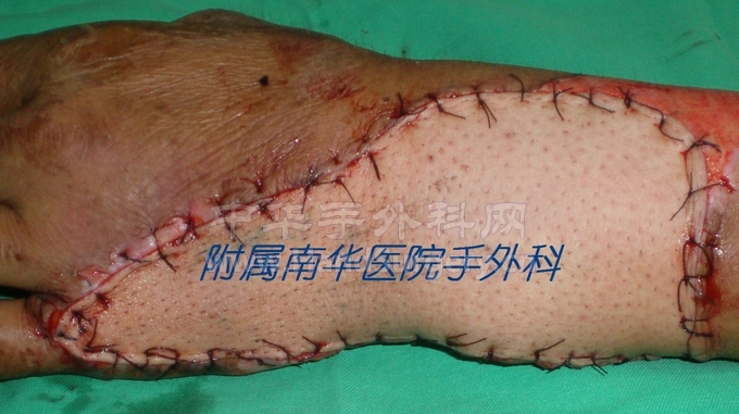 受区完美不需要二期手术